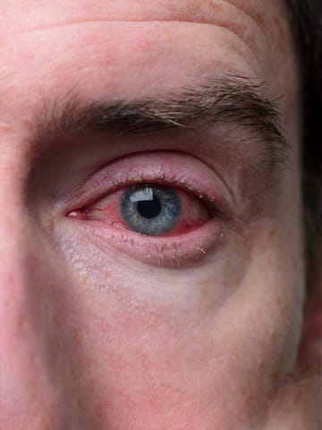 Home remedies for conjunctivitis