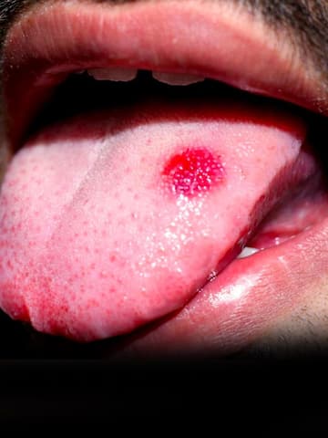 5 home remedies for sore tongue