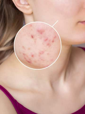 Foods that trigger acne breakouts